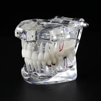 Zubné Model Zubov Implantát Obnova Mosta Výučby Štúdia Lekárske Vedy Choroby Stomatológia Stomatológia Produkty, Zubné Nástroje